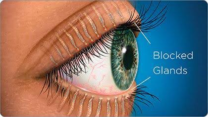 Meibomian Gland Dysfunction MGD Symptoms Causes And Expert 